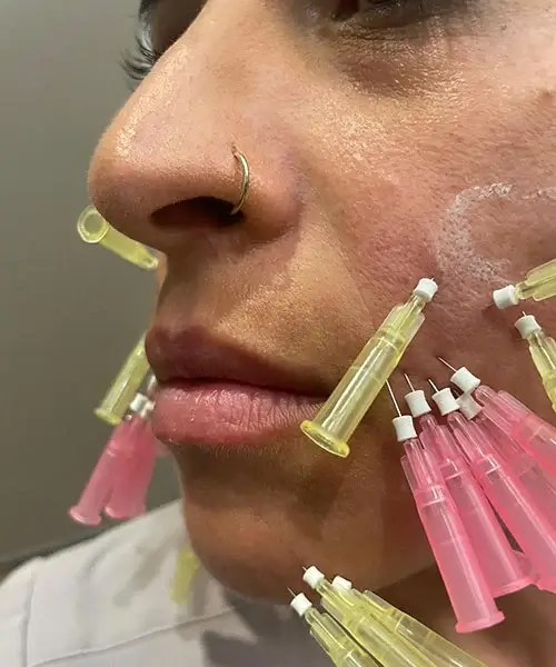 Lip Filler Injection: MicroCannula vs. Needle